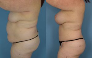 Mommy Makeover Before & After Patient Miniature Set