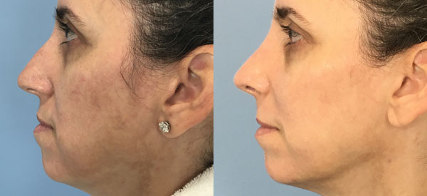 Photo of the patient’s face before & after the Rhinoplasty surgery. Set 2: Patient 17
