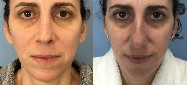 Photo of the patient’s face before & after the Rhinoplasty surgery. Set 1: Patient 17