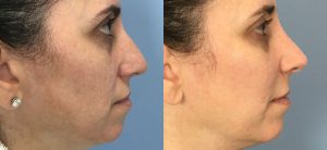 Rhinoplasty Before & After Patient Miniature Set