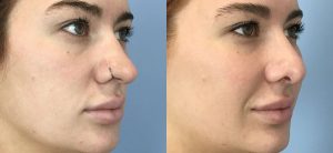 Rhinoplasty Before & After Patient19