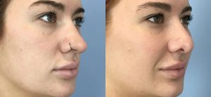 Rhinoplasty Before & After Patient Miniature Set