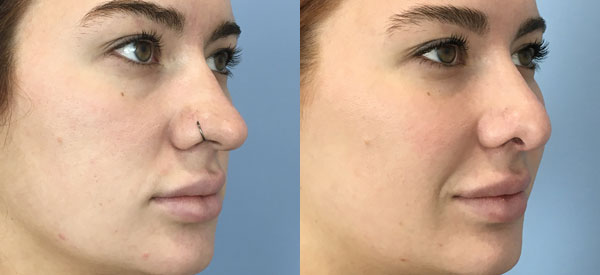 Photo of the patient’s face before & after the Rhinoplasty surgery. Set 2: Patient 18