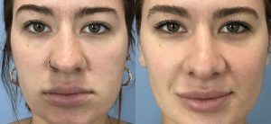 Rhinoplasty Before & After Patient Miniature Set