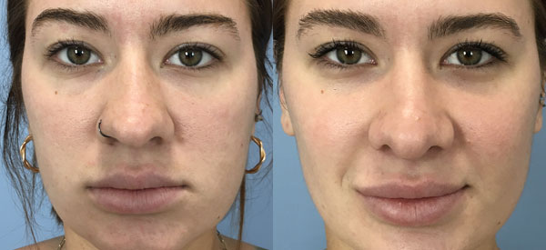 Photo of the patient’s face before & after the Rhinoplasty surgery. Set 1: Patient 18