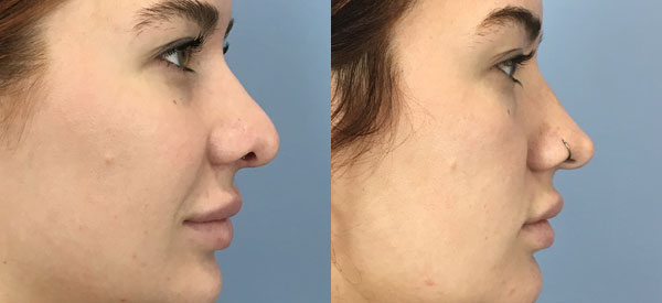 Photo of the patient’s face before & after the Rhinoplasty surgery. Set 3: Patient 18