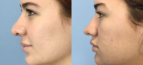 Photo of the patient’s face before & after the Rhinoplasty surgery. Set 4: Patient 18