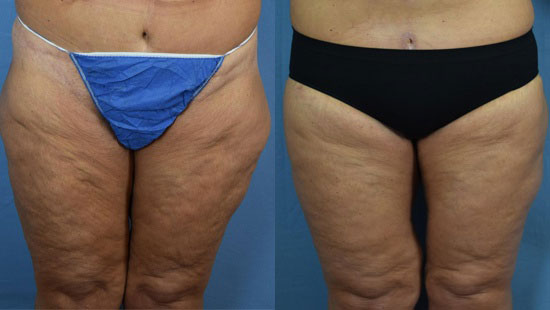 Photo of the patient’s body before & after the Thigh Lift surgery. Set 1: Patient 2