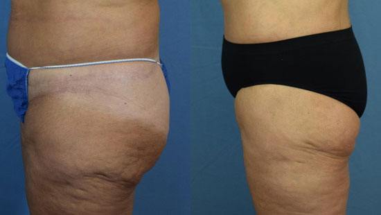 Photo of the patient’s body before & after the Thigh Lift surgery. Set 2: Patient 2