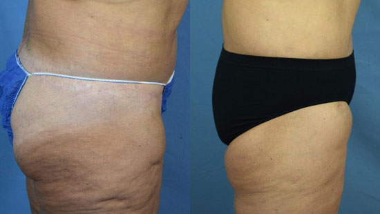 Photo of the patient’s body before & after the Thigh Lift surgery. Set 3: Patient 2