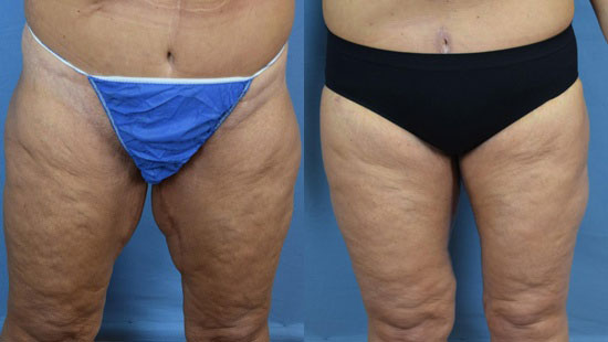 Photo of the patient’s body before & after the Thigh Lift surgery. Set 4: Patient 2