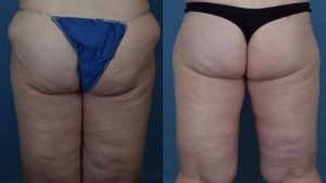 Thigh Lift Before & After Patient Miniature Set