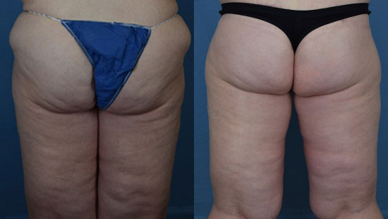 Photo of the patient’s body before & after the Thigh Lift surgery. Set 1: Patient 3
