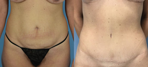Female body, before and after Tummy Tuck treatment, front view, patient 36