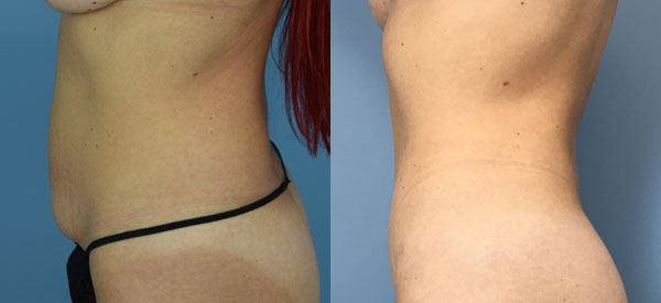 Female body, before and after Tummy Tuck treatment, l-side view, patient 36