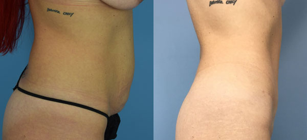 Female body, before and after Tummy Tuck treatment, r-side view, patient 36
