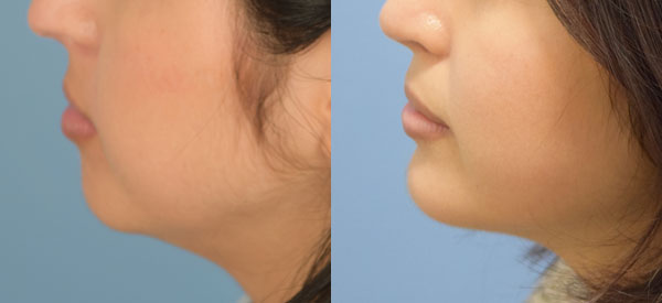 Photo of the patient’s face before & after the Chin Implant surgery. Set 1: Patient 1