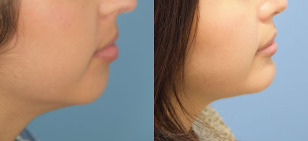 Photo of the patient’s face before & after the Chin Implant surgery. Set 2: Patient 1