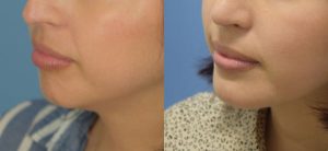 Chin Implant Before & After Patient Miniature Set
