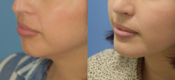 Photo of the patient’s face before & after the Chin Implant surgery. Set 3: Patient 1