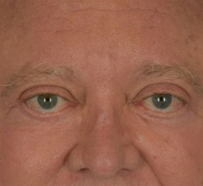 Male face, after Male Eyelid treatment, front view