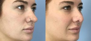 Cheek Implants Before & After Patient Miniature Set