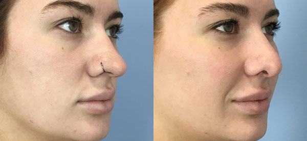 Photo of the patient’s face before & after the Cheek Implants surgery. Set 1: Patient 1