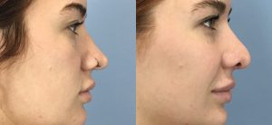 Cheek Implants Before & After Patient Miniature Set
