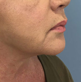 Chin after, side view