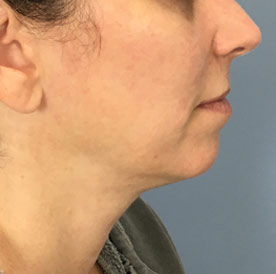 Female Facial Implant, after treatment, side view