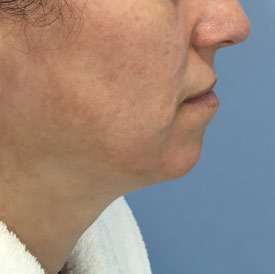 Female Facial Implant, before treatment, side view