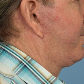 Male body, after necklift treatment, side view
