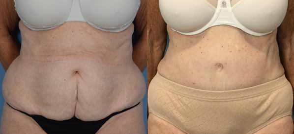 Female body, before and after Tummy Tuck treatment, front view, patient 29