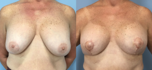 Breast Lift Before & After Patient Miniature Set