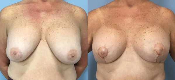 Photo of the patient’s body before & after the Breast Lift surgery. Set 1: Patient 6