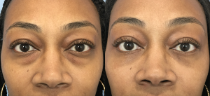 Fat Transfer Before & After Patient Miniature Set