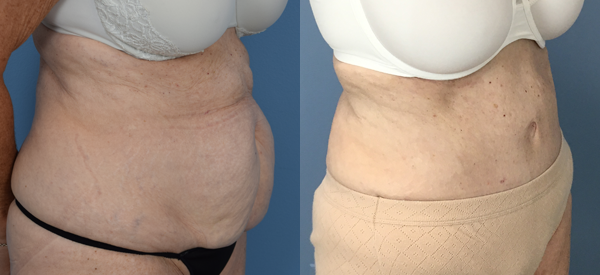 Female body, before and after Tummy Tuck treatment, r-side oblique view, patient 29