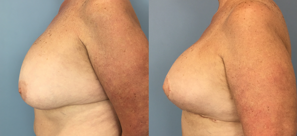 Photo of the patient’s body before & after the Breast Lift surgery. Set 2: Patient 6