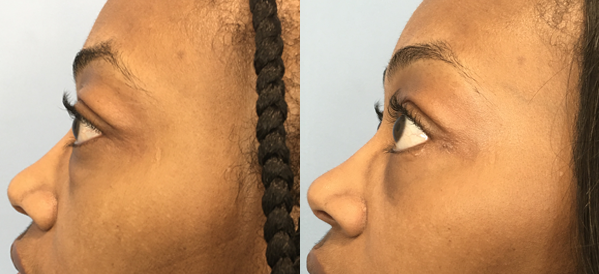 Photo of the patient’s face before & after the Fat Transfer surgery. Set 2: Patient 4