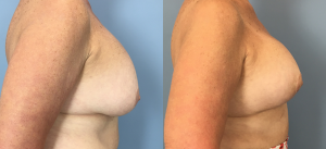 Breast Lift Before & After Patient Miniature Set