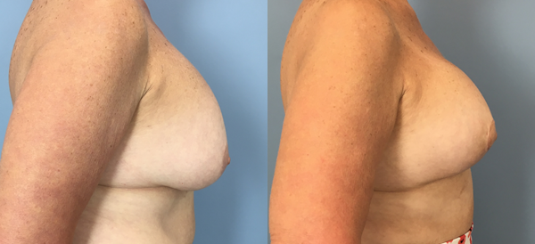 Photo of the patient’s body before & after the Breast Lift surgery. Set 3: Patient 6