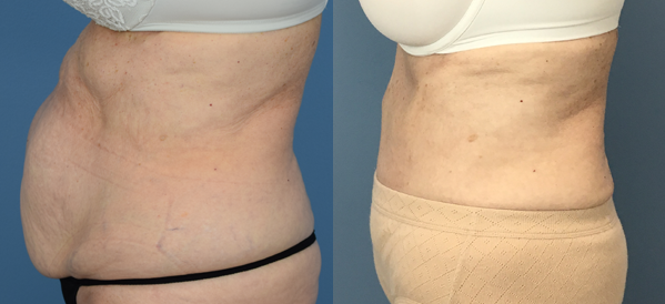 Female body, before and after Tummy Tuck treatment, l-side view, patient 29