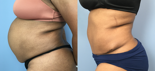 Female body, before and after Tummy Tuck treatment, l-side view, patient 23