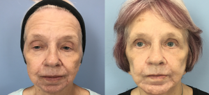 Facelift Before & After Patient Miniature Set