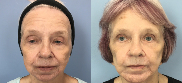 Photo of the patient’s face before & after the Facelift surgery. Set 1: Patient 2
