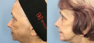 Facelift Before & After Patient Miniature Set