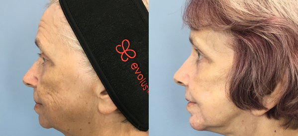 Photo of the patient’s face before & after the Facelift surgery. Set 2: Patient 2
