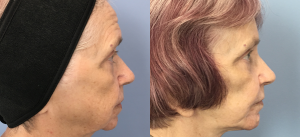 Facelift Before & After Patient Miniature Set