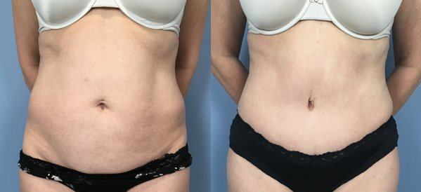 Female body, before and after Tummy Tuck treatment, front view, patient 37