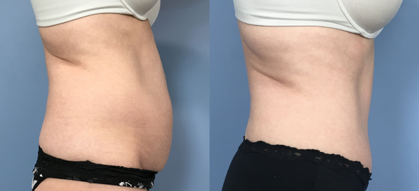 Female body, before and after Tummy Tuck treatment, r-side view, patient 37
